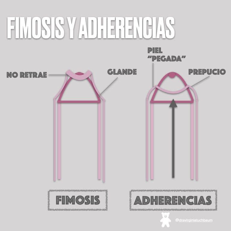 Esquema que compara un prepucio que se retrae con una balanitis xerótica obliterante, cuando la piel se ve blanca nacarada.